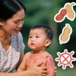 Chăm sóc dị ứng ở trẻ em tại Việt Nam: Nhận biết và quản lý dị ứng thực phẩm, chàm sữa và các bệnh dị ứng khác