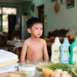 Dị ứng da ở trẻ em do thuốc tẩy và thức ăn: Biểu hiện, nguyên nhân và cách phòng ngừa an toàn tại Việt Nam