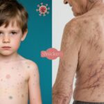 Thủy Đậu và Zona: Tại Sao Cùng Một Loại Virus Gây Ra Hai Bệnh Khác Nhau?